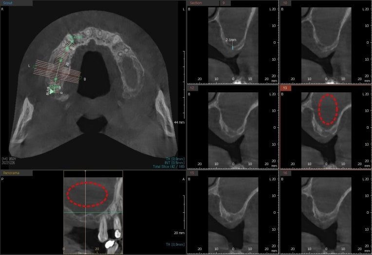 여러 단면으로 남은 뼈와 상악동 염증 부위를 표시한 3D CT 화면