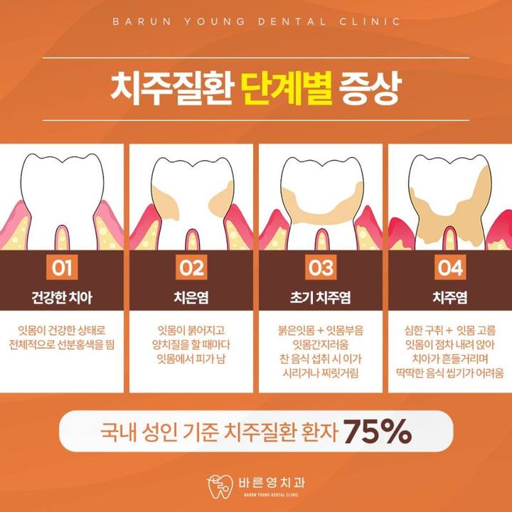 약수역치과, 치아 상실할 수도 있는 잇몸질환 예방하려면 사진 5