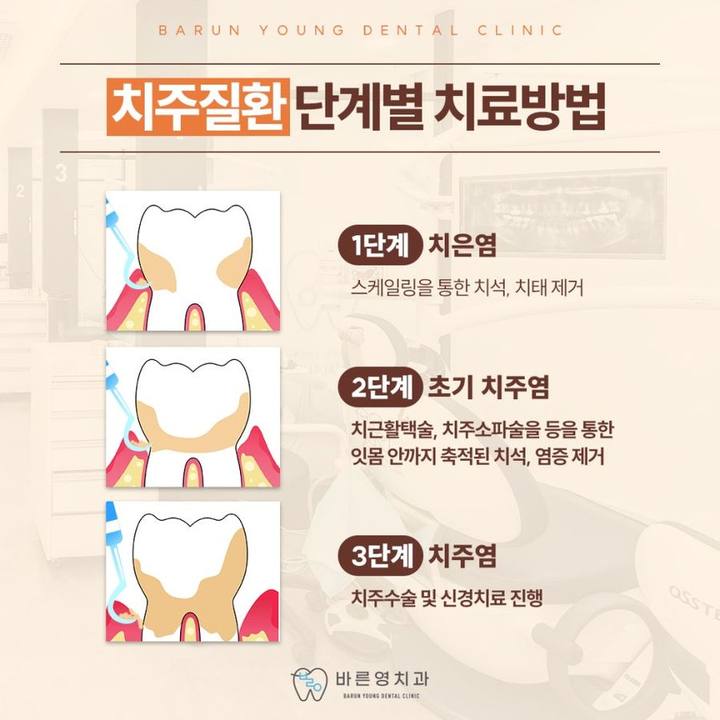 충무로치과 스케일링, 자꾸 피나고 찌릿하는 잇몸통증 이유는 치주질환? 사진 10