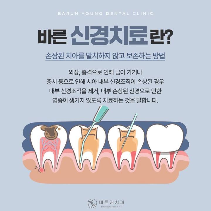 청구동치과 충치치료 신경치료 시기 놓치지 말고 사진 8