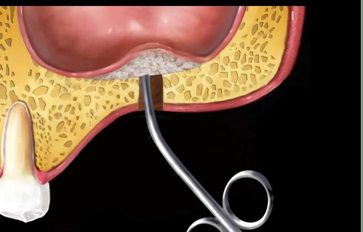 수직적 / 측방적