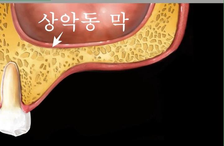 신당동 치과 오래전 빠진 치아 상태에서 임플란트 수술(상악동 거상술) 사진 2