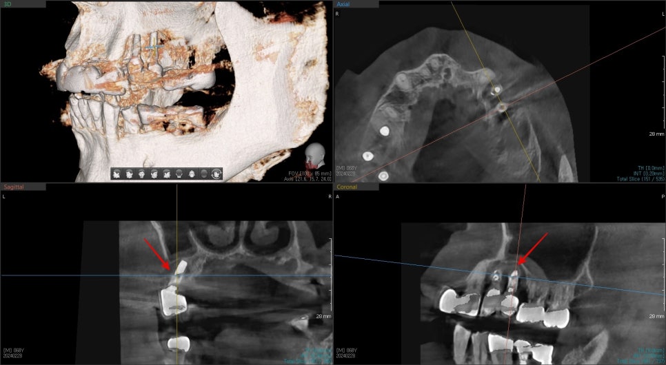 임플란트 주변 뼈 지지가 부족한 부위를 표시한 3D CT
