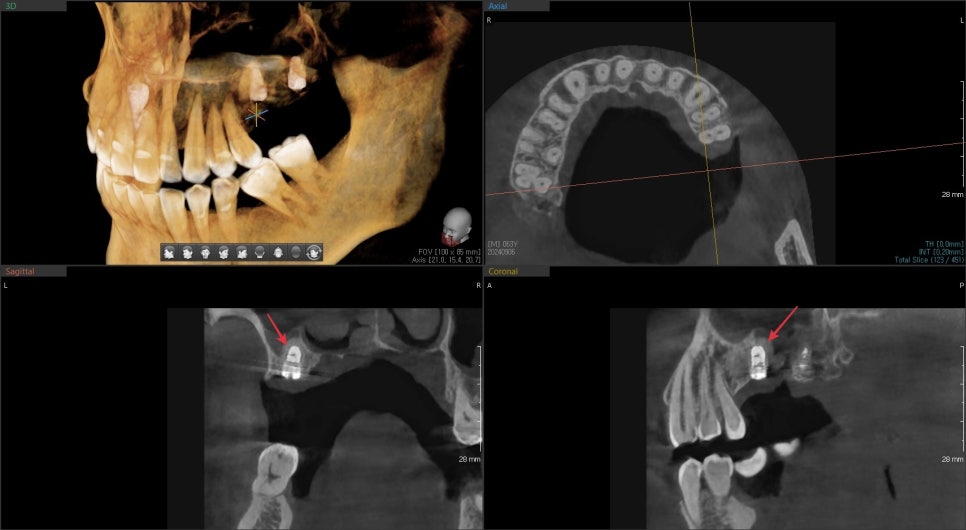 수술 후 3D CT: 임플란트 주변이 골이식재로 채워진 모습