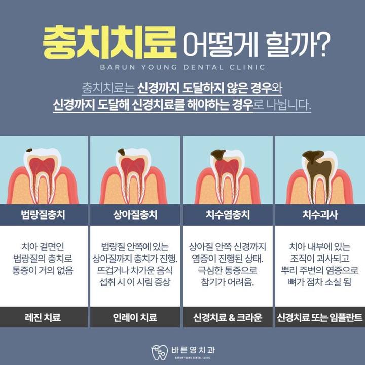 청구동치과 충치치료 신경치료 시기 놓치지 말고 사진 7
