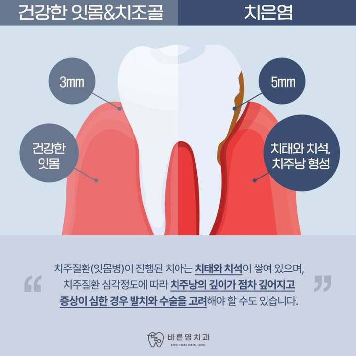 금호동치과 자주 나는 잇몸 피 치주질환 치료로 사진 4