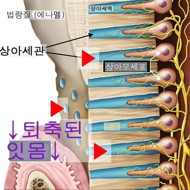 약수역 치과, 치경부마모증 치아에는 어떤 치료를 해야될까요??(시린이 치아의 원인과 해결방법) 사진 2