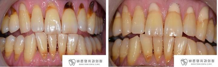 약수역 치과, 치경부마모증 치아에는 어떤 치료를 해야될까요??(시린이 치아의 원인과 해결방법) 사진 3