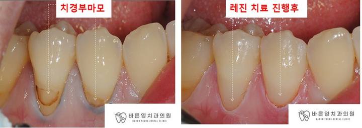 약수역 치과, 치경부마모증 치아에는 어떤 치료를 해야될까요??(시린이 치아의 원인과 해결방법) 사진 4