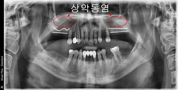 희색선=남아있는 치조골, 빨간원=상악동공간