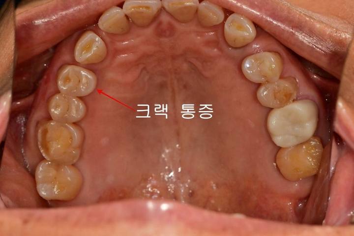 신당동 치과 씹을 때마다 아플 때 임플란트 치아의 문제 사진 2