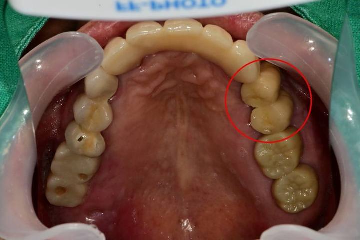 신당동 치과 씹을 때마다 아플 때 임플란트 치아의 문제 사진 8