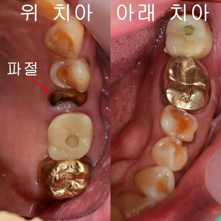버티고개역 치과 깨지고 닳은 치아 회복하는 방법 사진 1