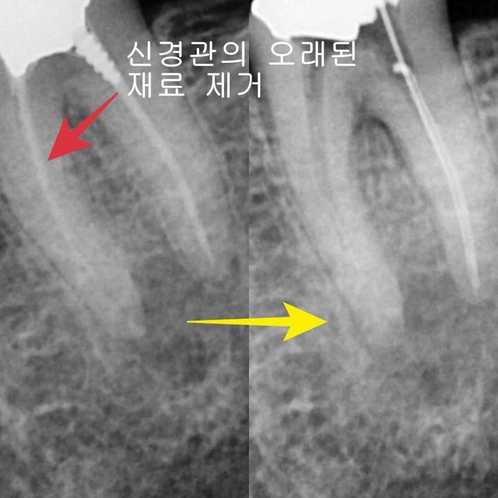 옥수동 크라운치료된 통증 있는 치아의 (재)신경치료 과정 사진 10