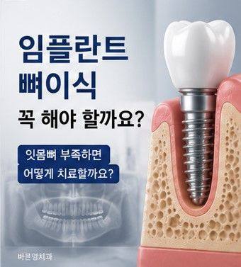 약수역 임플란트, 뼈이식 없이 가능한 경우도 있을까요? 사진 1