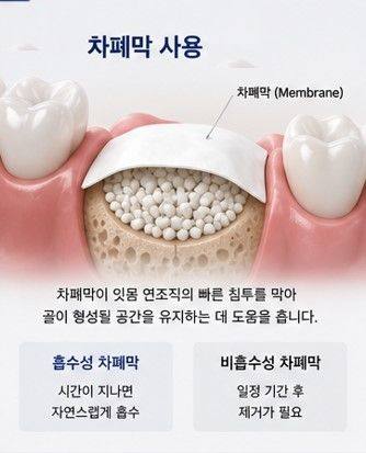 약수역 임플란트, 뼈이식 없이 가능한 경우도 있을까요? 사진 2
