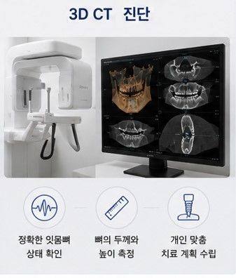 약수역 임플란트, 뼈이식 없이 가능한 경우도 있을까요? 사진 4