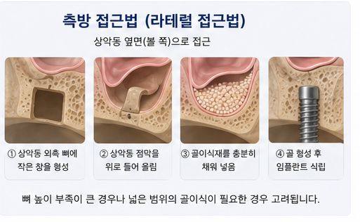 약수역 치과, 임플란트 상악동 거상술, 꼭 필요한 경우는? 사진 6