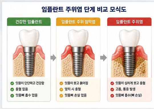 약수역 치과, 임플란트도 잇몸병이 생길 수 있을까요? 사진 1