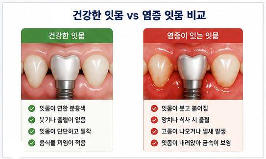 약수역 치과, 임플란트도 잇몸병이 생길 수 있을까요? 사진 4