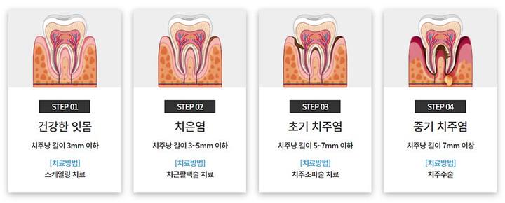 약수역치과, 양치할 때 피 난다면 잇몸염증치료 필요해요 사진 10