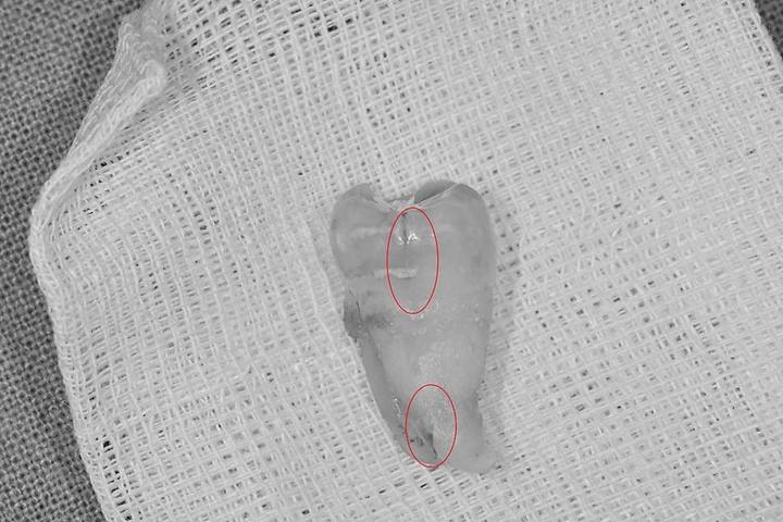 약수역 치과, 금 간 치아( 크랙 치아)로 인한 뿌리 주변 염증이 생겼을 때 치료방법( 임플란트, 치조골 이식술) 사진 3