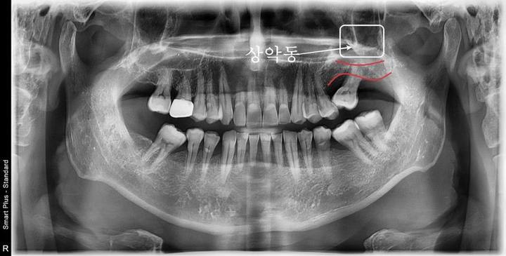 신당동 치과 오래전 빠진 치아 상태에서 임플란트 수술(상악동 거상술) 사진 1