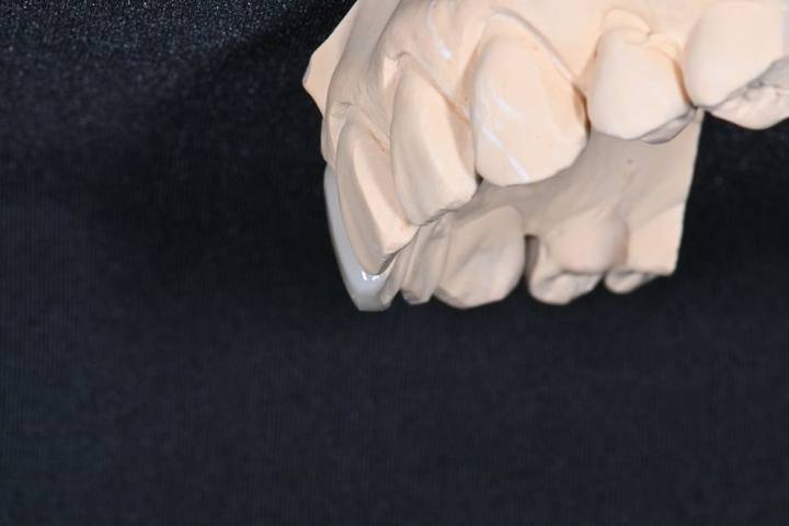 동대문 무삭제라미네이트 과거 교정한 치아가 웃을 때 안 보여 스트레스일 때 사진 3