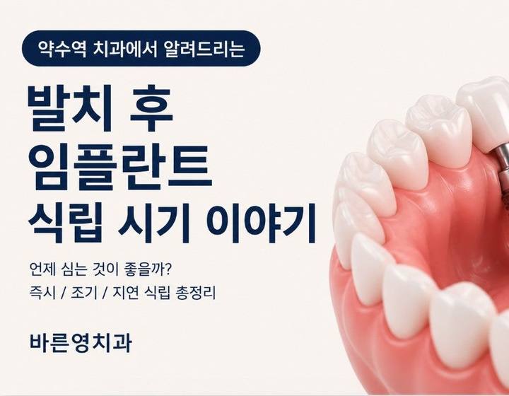 약수역 치과 발치후 임플란트 식립시기는 어떻게 정해질까요? 사진 1