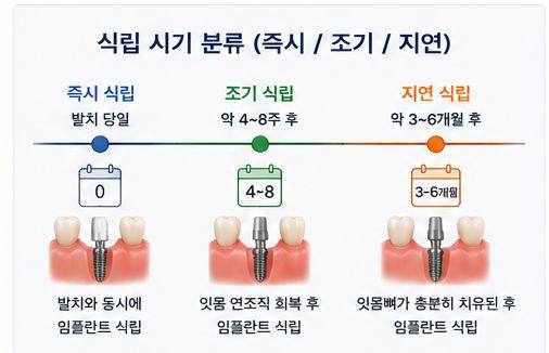 약수역 치과 발치후 임플란트 식립시기는 어떻게 정해질까요? 사진 3