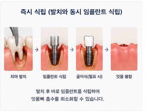 약수역 치과 발치후 임플란트 식립시기는 어떻게 정해질까요? 사진 4