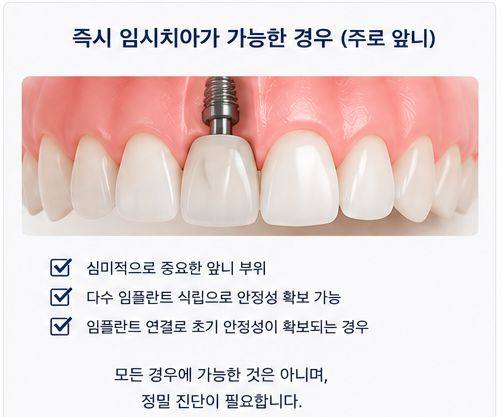 약수역 치과 발치후 임플란트 식립시기는 어떻게 정해질까요? 사진 6
