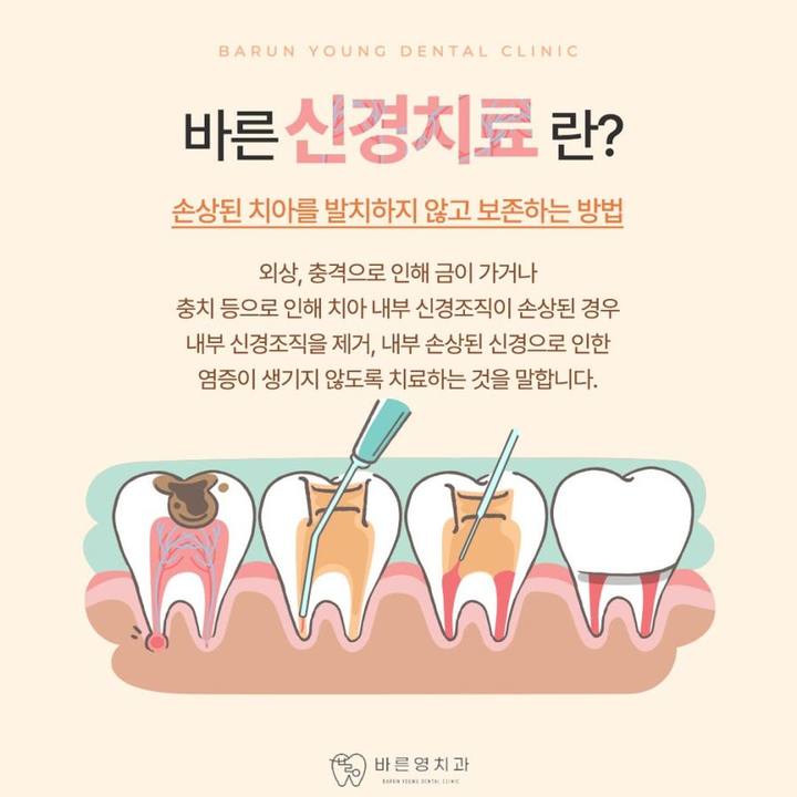 충무로치과, 자연치아 살리기를 우선으로 생각하는 충치치료 사진 6