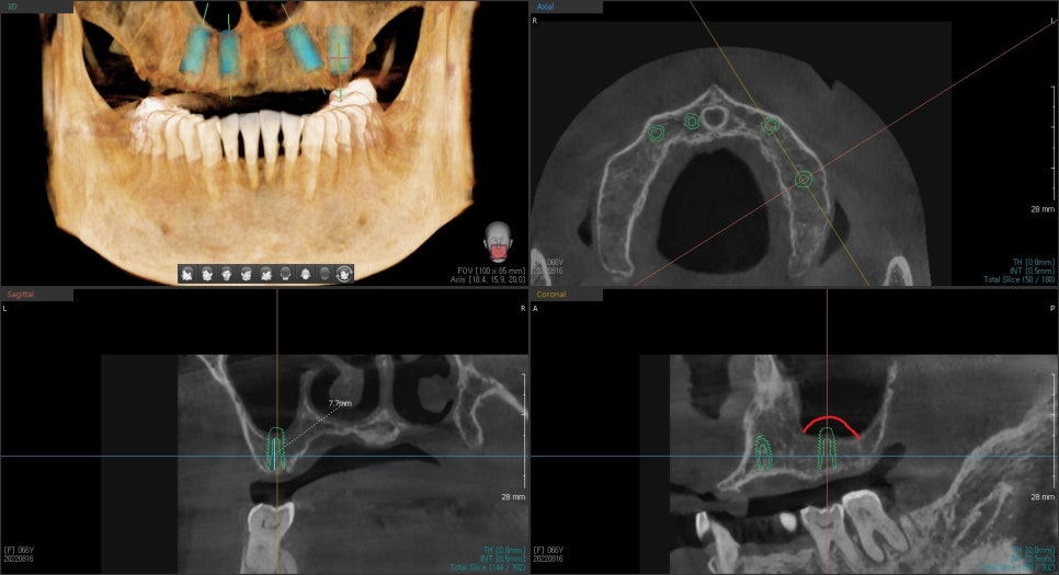 3D CT 시뮬레이션 화면에서 임플란트 위치와 각도를 계획하는 모습