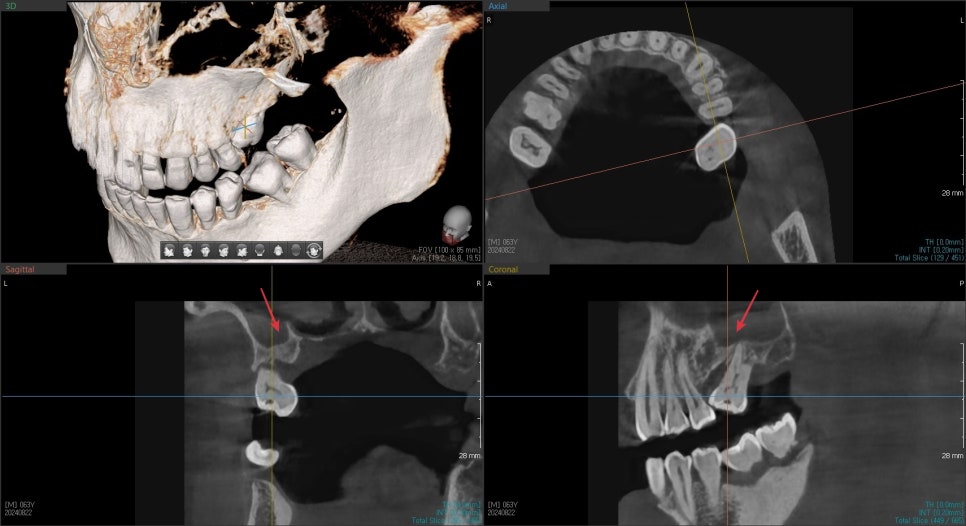 수술 전 3D CT: 상악동 아래 잔존골이 얇은 상태