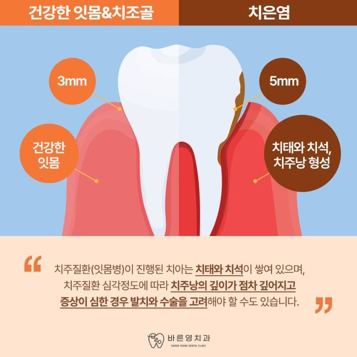 장충동치과, 구취가 계속된다면 치주염일 수 있어요 사진 4