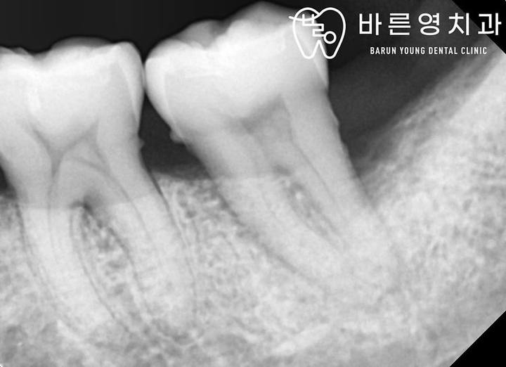 바른영치과 신경치료 사례