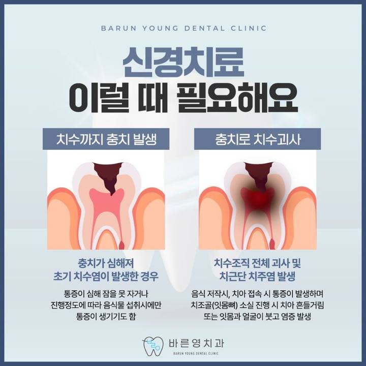 약수역치과, 충치치료 신경치료 증상 없더라도 미리 대비해야 사진 5