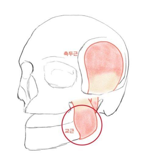신당동 치과, 턱 보톡스 주사 이후에 나타날 수 있는 증상 ( 사각턱, 저작근, 볼 알사탕 현상) 사진 1