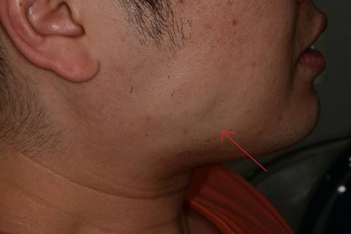 신당동 치과, 턱 보톡스 주사 이후에 나타날 수 있는 증상 ( 사각턱, 저작근, 볼 알사탕 현상) 사진 2