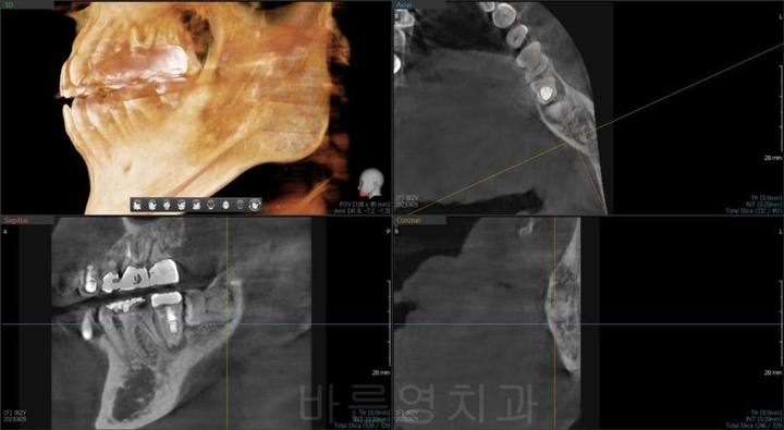 신당역 치과, 임플란트를 수술을 위해 사랑니는 꼭 빼야 하나요?? (얼마나 기다려야 임플란트 치료가 가능한가요?) 사진 2