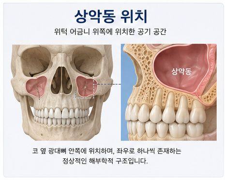 약수역 치과, 임플란트 상악동 거상술, 꼭 필요한 경우는? 사진 1