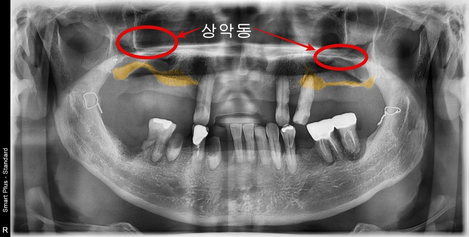 치료 전 초진 파노라마: 다수 치아 상실과 얇아진 위턱 뼈