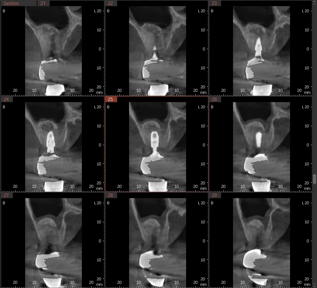 위턱에 골이식과 함께 임플란트를 심은 뒤 촬영한 3D CT 단면 사진