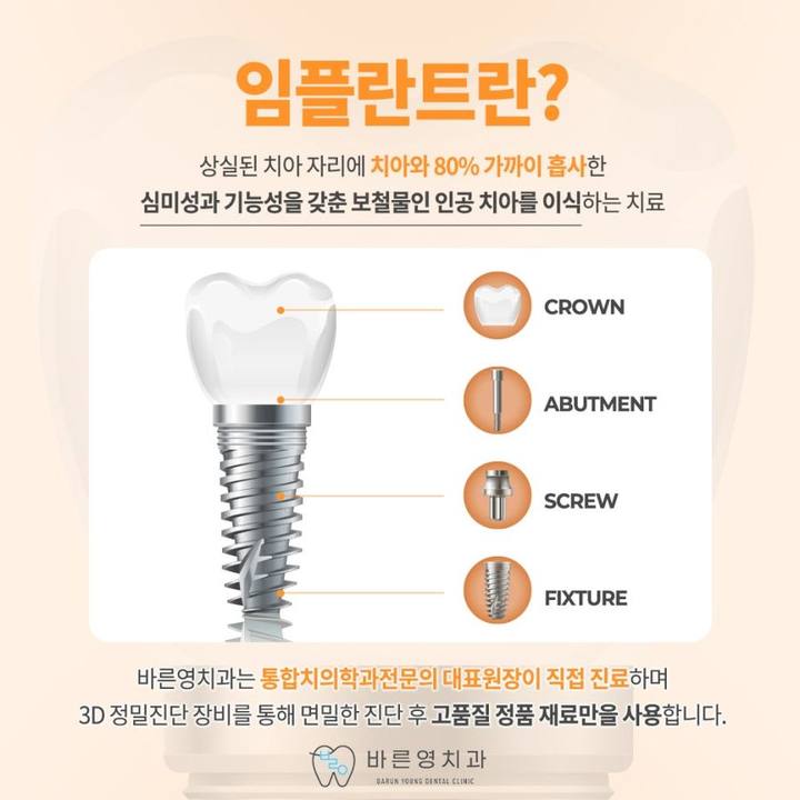 청구동치과, 인공치아 식립할 위치를 찾아주는 네비게이션 임플란트 사진 3