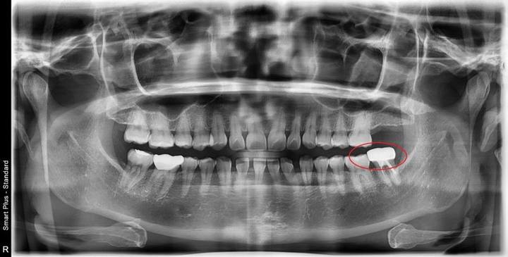 약수역 치과, 발치 후 임플란트를 미루면 생기는 일(임플란트, 크라운치료, 신경치료) 사진 1