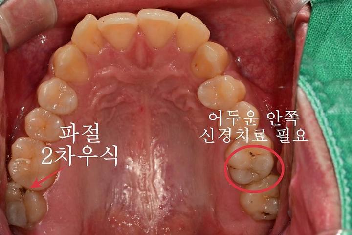서울중구치과치료 신경치료받은 치아 크라운이 필요한가요? 사진 2
