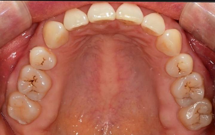 동대문 무삭제라미네이트 과거 교정한 치아가 웃을 때 안 보여 스트레스일 때 사진 2