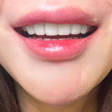 동대문 무삭제라미네이트 과거 교정한 치아가 웃을 때 안 보여 스트레스일 때 사진 9