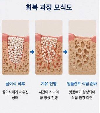 약수역 임플란트, 뼈이식 없이 가능한 경우도 있을까요? 사진 3